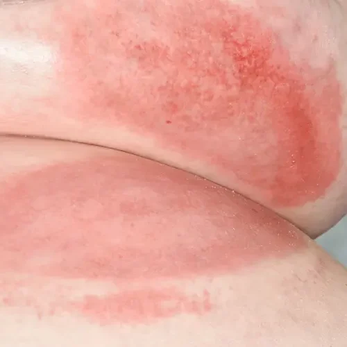 Sweaty Skin Irritation: Reduce Friction and Keep Skin Dry