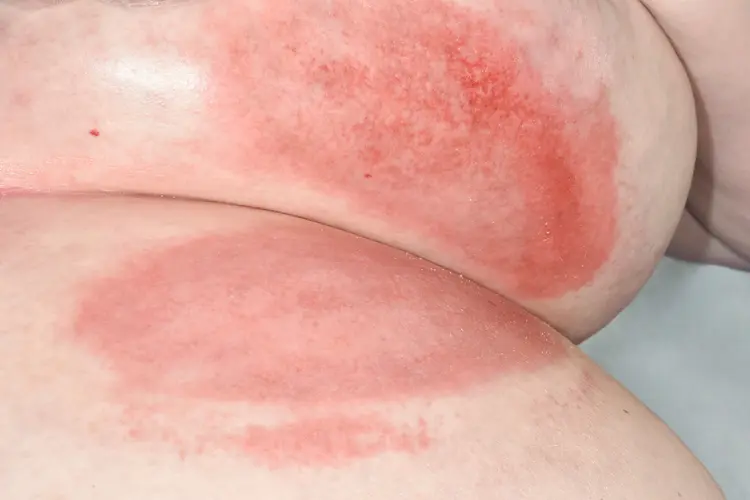 Sweaty Skin Irritation: Reduce Friction and Keep Skin Dry